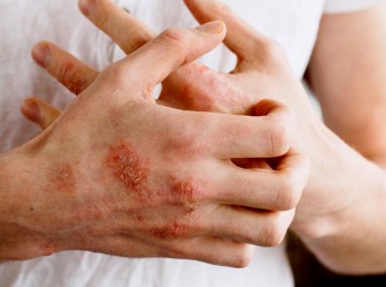 误解最深的银屑病